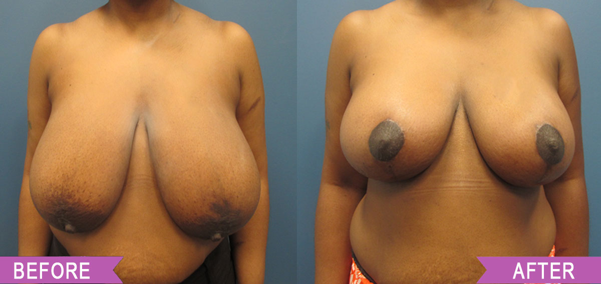 Breast_Reduction_By_North_Shore_Center_for_Plastic_Surgery13