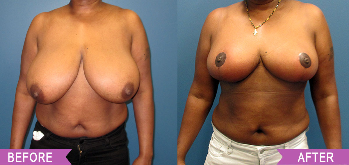 Breast_Reduction_By_North_Shore_Center_for_Plastic_Surgery_928