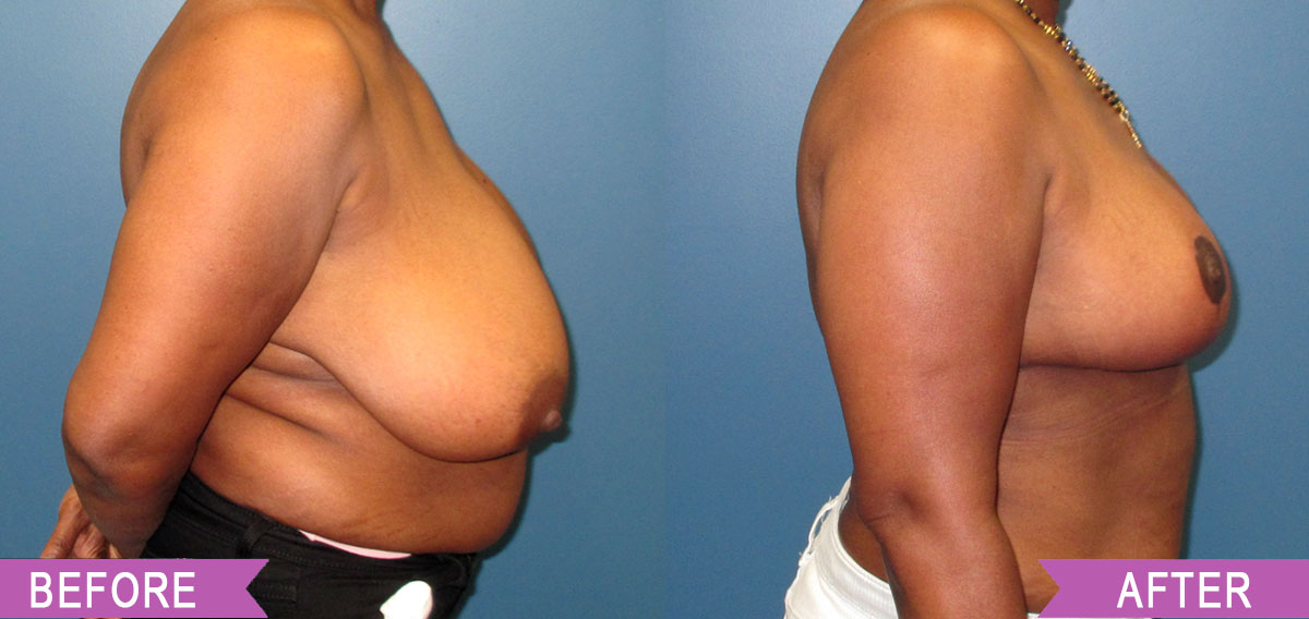 Breast_Reduction_By_North_Shore_Center_for_Plastic_Surgery_9283