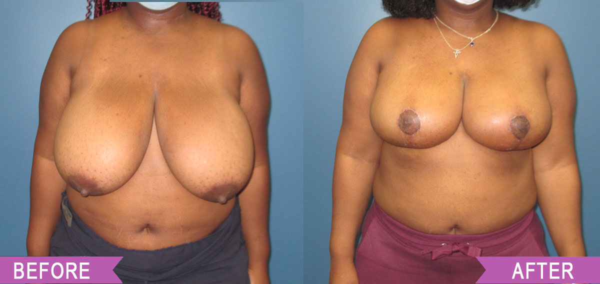 Breast_Reduction_By_North_Shore_Center_for_Plastic_Surgery18