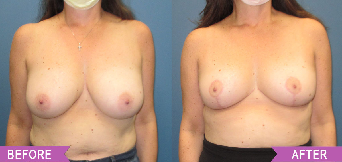 Breast_Reduction_By_North_Shore_Center_for_Plastic_Surgery_33