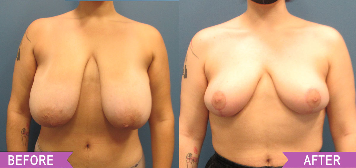 Breast_Reduction_By_North_Shore_Center_for_Plastic_Surgery_34