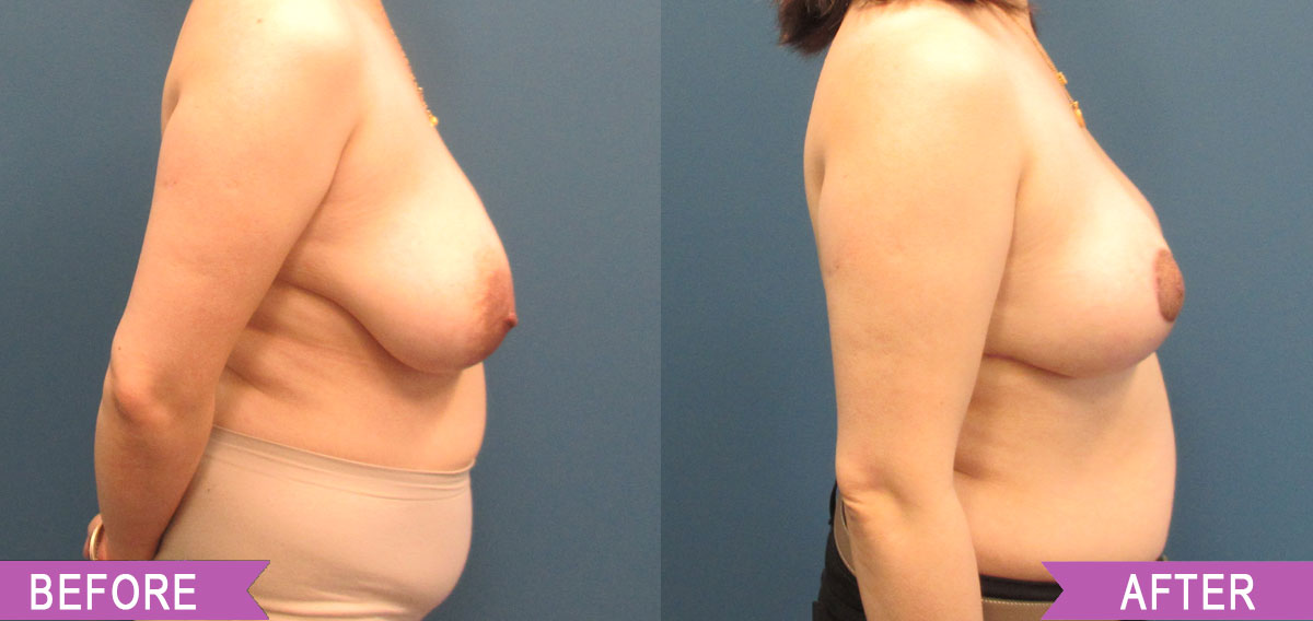 Breast_Reduction_By_North_Shore_Center_for_Plastic_Surgery_35