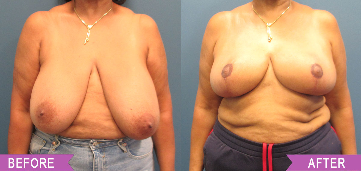 Breast_Reduction_By_North_Shore_Center_for_Plastic_Surgery_37