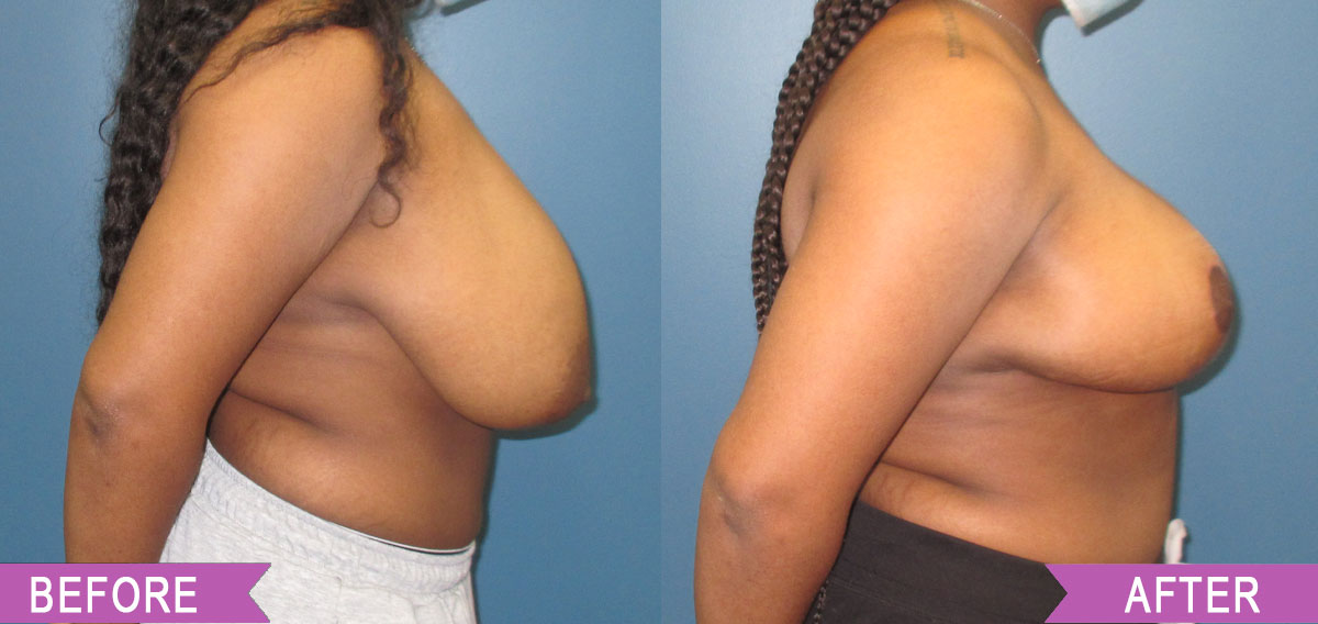 Breast_Reduction_By_North_Shore_Center_for_Plastic_Surgery_39