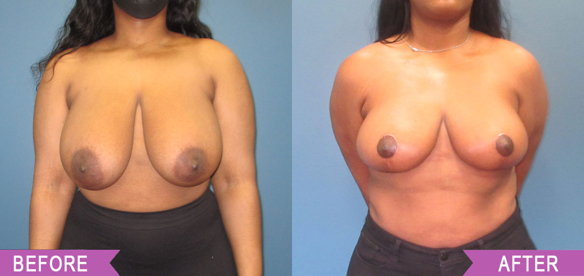 Breast_Reduction_By_North_Shore_Center_for_Plastic_Surgery1_3
