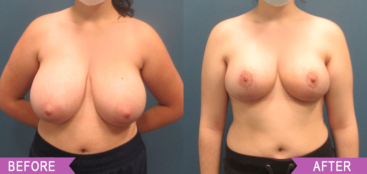 Breast_Reduction_By_North_Shore_Center_for_Plastic_Surgery1_32