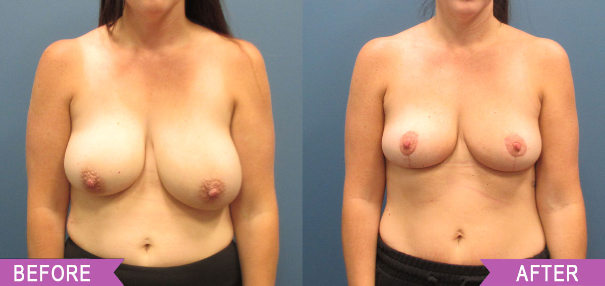 Breast_Reduction_By_North_Shore_Center_for_Plastic_Surgery1_33
