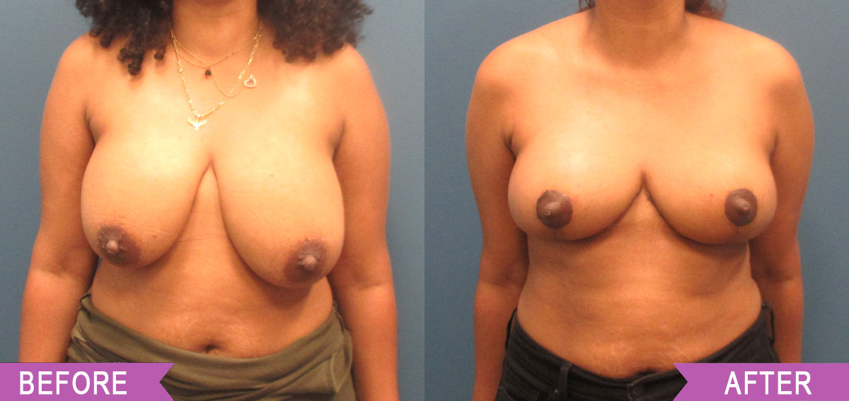 Breast_Reduction_By_North_Shore_Center_for_Plastic_Surgery1_39